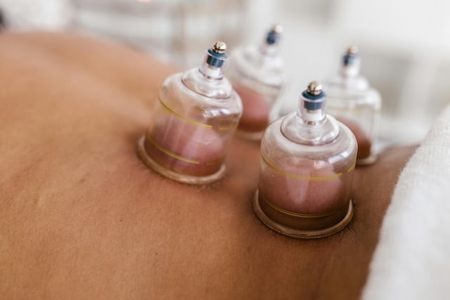 Cupping Therapy at Home