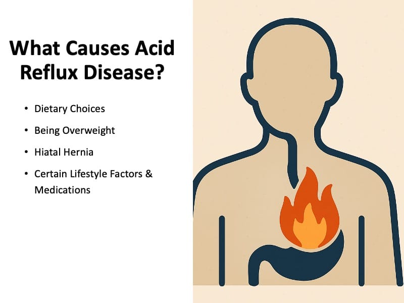What Causes Acid Reflux Disease